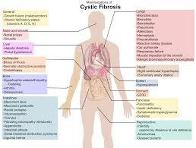 Cystic Fibrosis
