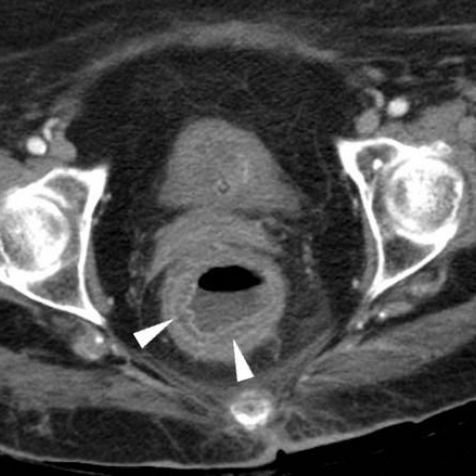 Chemical Proctitis