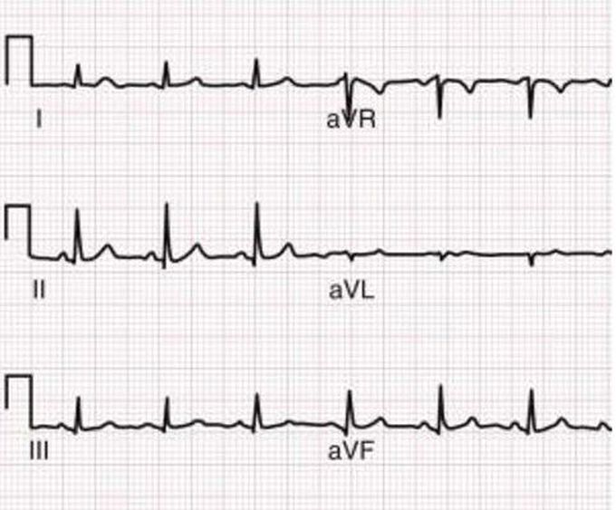 Axis  deviation