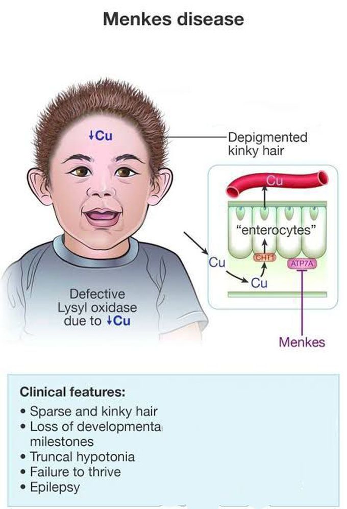 These are the clinical features of Menkes disease