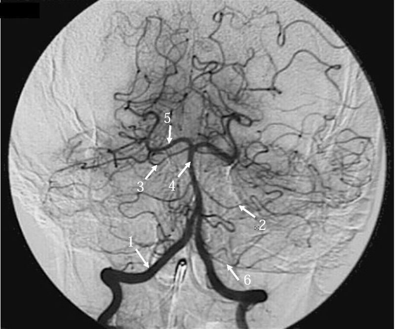 Circle Of Willis Angiogram Labeled
