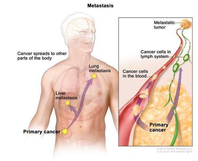 Metastasis