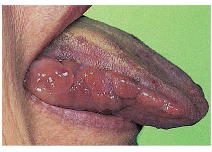 Amyloidosis