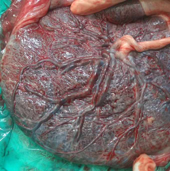 Placenta & umbilical cord