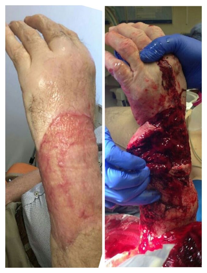 Muscle graft surgery -accident case