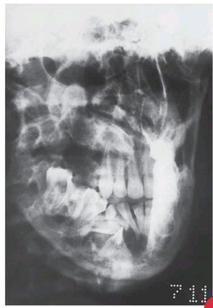 Gorlin's syndrome