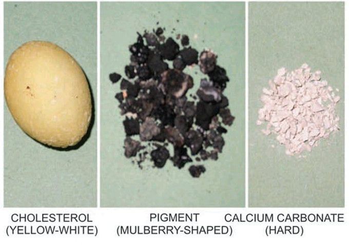 Gallstones