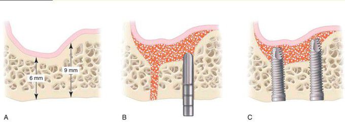 Indirect sinus elevation procedure