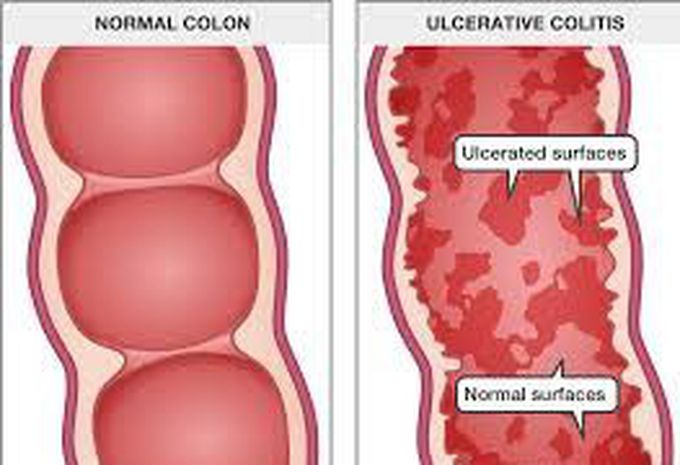Ulcerative cholitis