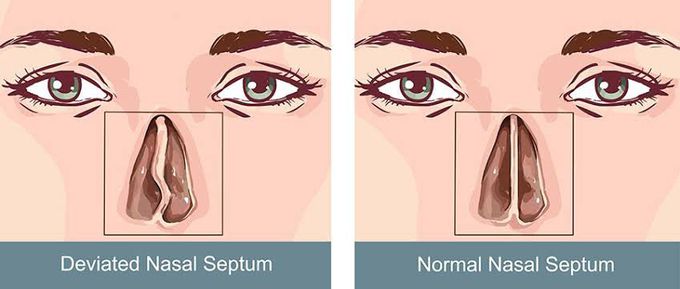 This is the difference between a normal and deviated nasal septum