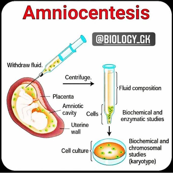 Amniocentesis