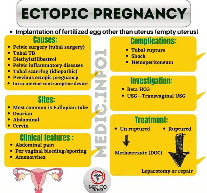 Ectopic Pregnancy Medizzy