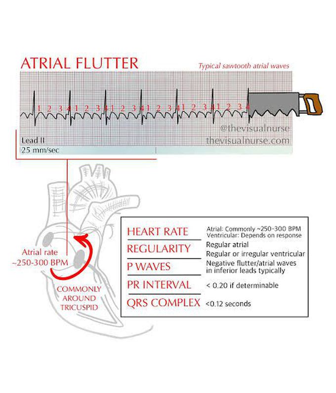 Atrial Flutter