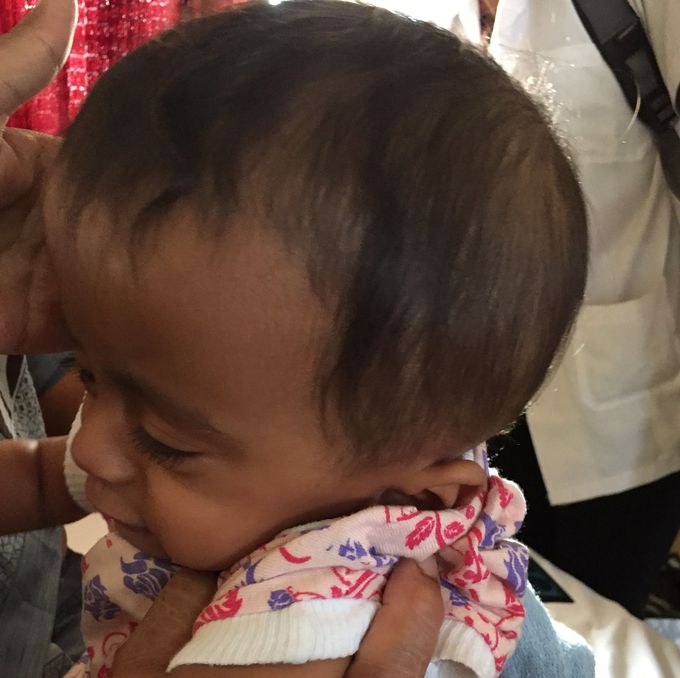 Hydrocephalus
