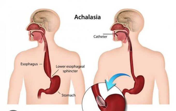 Treatment for Achalasia