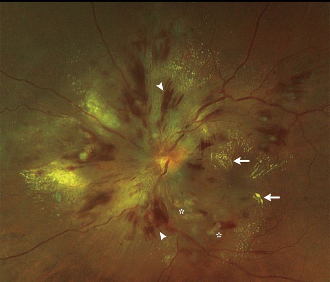 Retinopathy in Malignant Hypertension