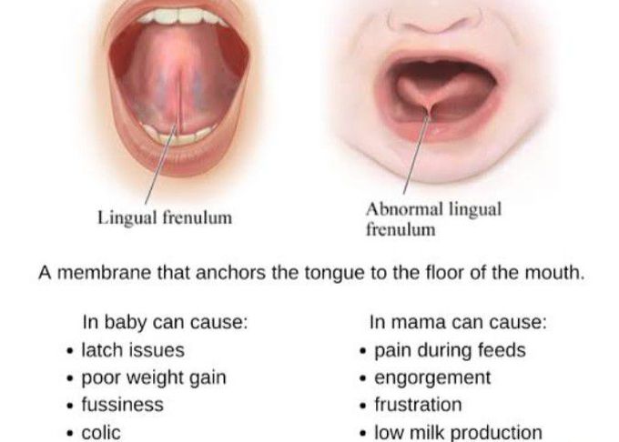 Causes of lingual frenulum