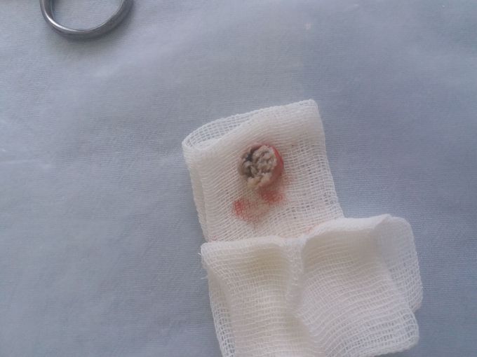 Inside lipoma