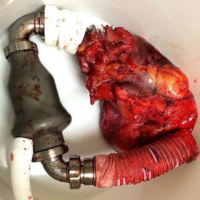 This is a real device called an LVAD (left ventricular assist device). . 