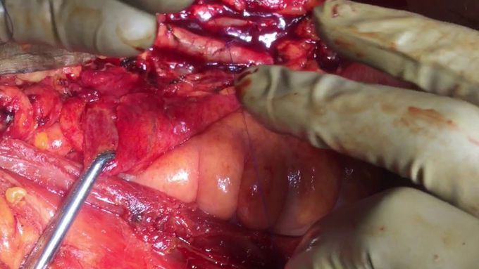 Suturing Inferior Vena Cava Injury