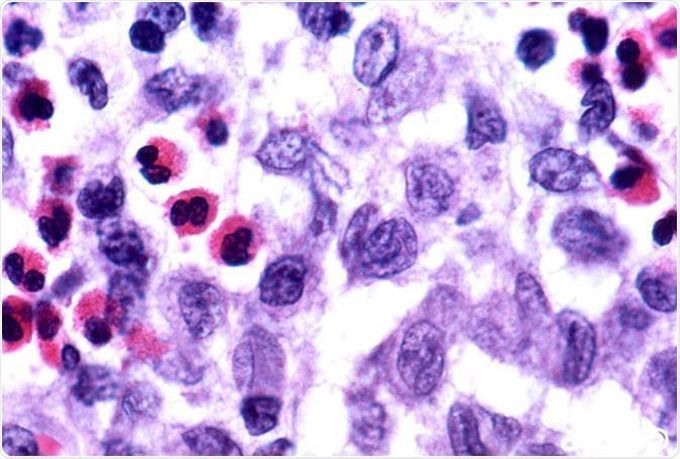 Langerhan cell histiocytosis