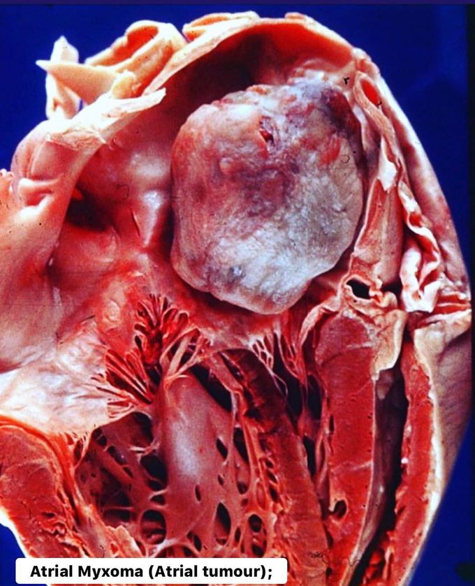 A tumor in the heart - atrial myxoma