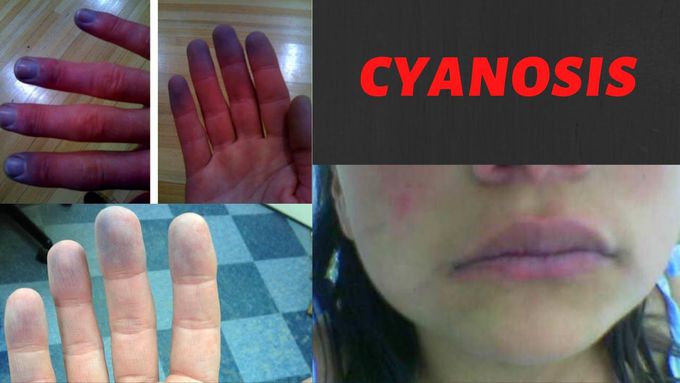 Cyanosis