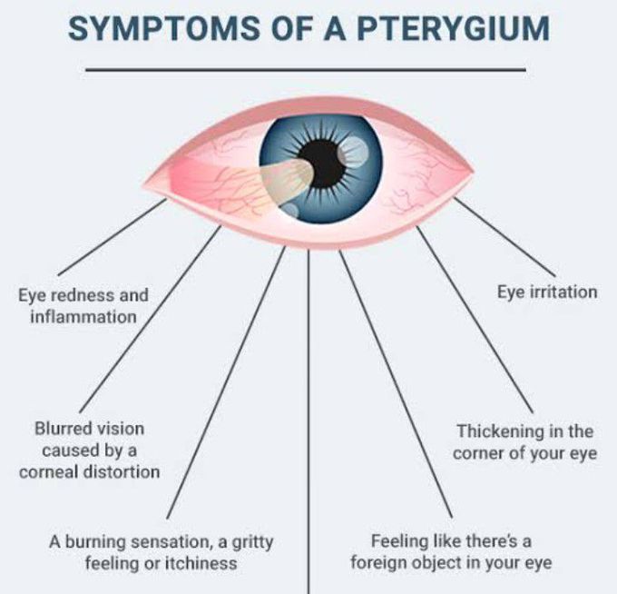 Symptoms of pterygium