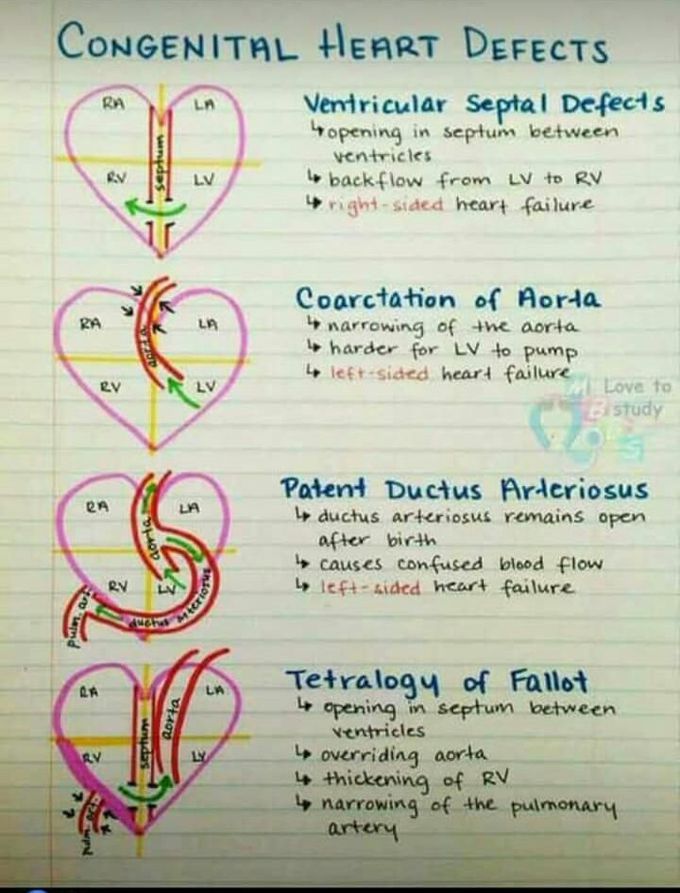 Congenital heart defect