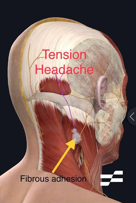 Cause Of Tension Headache Medizzy 