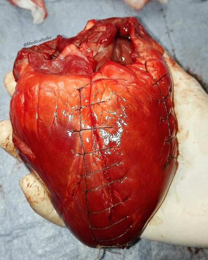 Cardiac sutures!! 