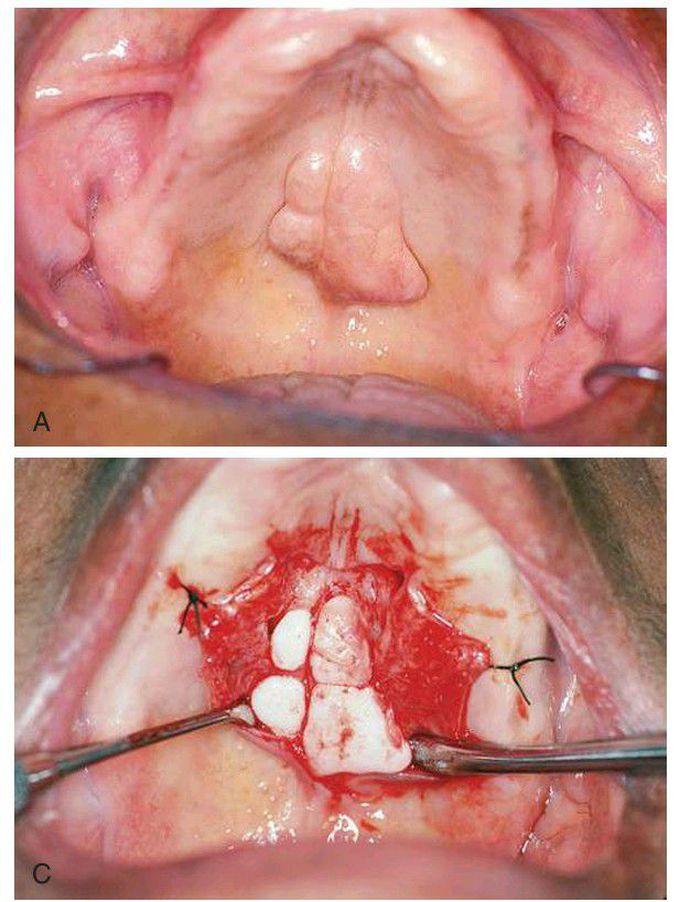 Removal of a palatal torus