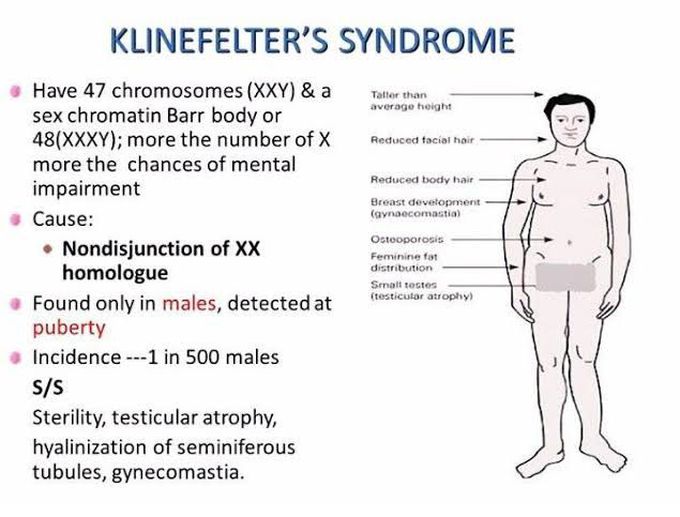 Klinefelter's Syndrome