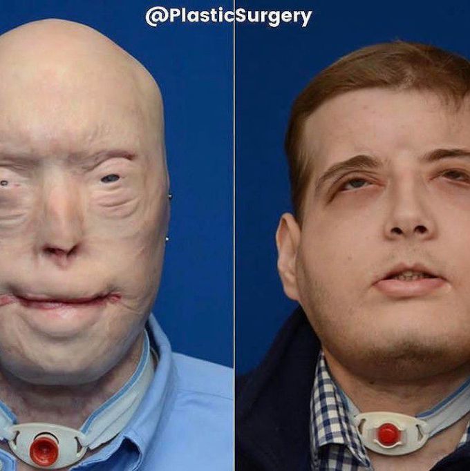 One of the biggest challenges plastic surgery ever faced.