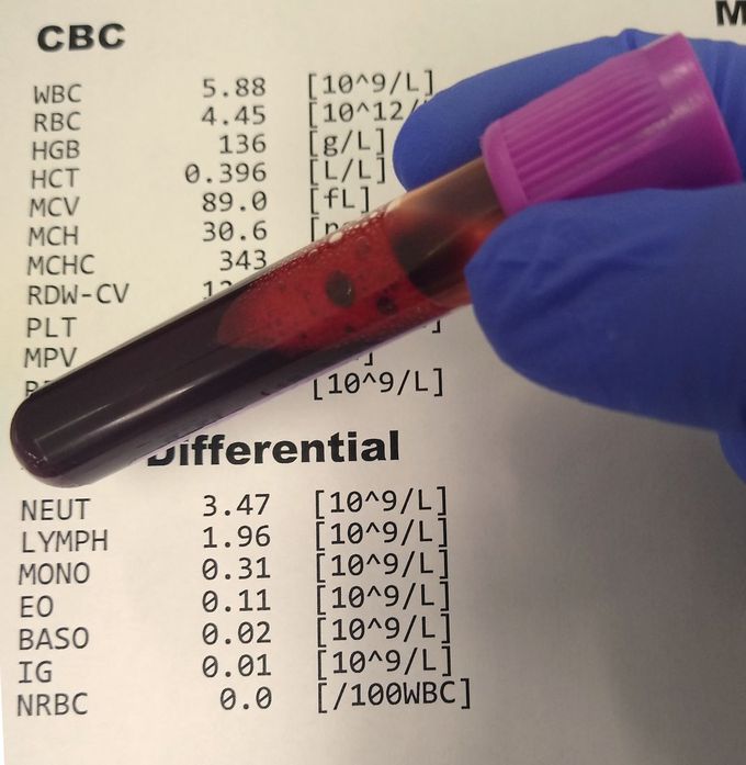 complete-blood-count-cbc-medizzy