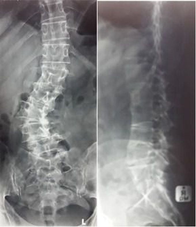 Degenerative scoliosis