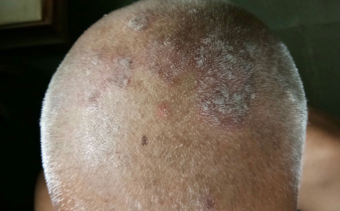 Scalp lesion