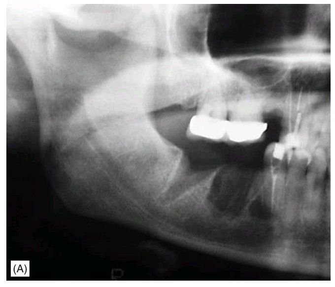Bisphosphonate-induced osteonecrosis.