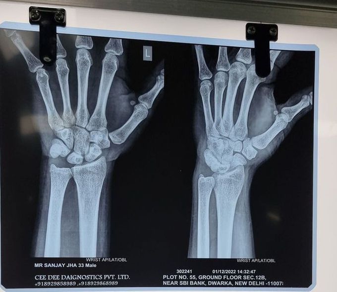 Identify the Fracture Site