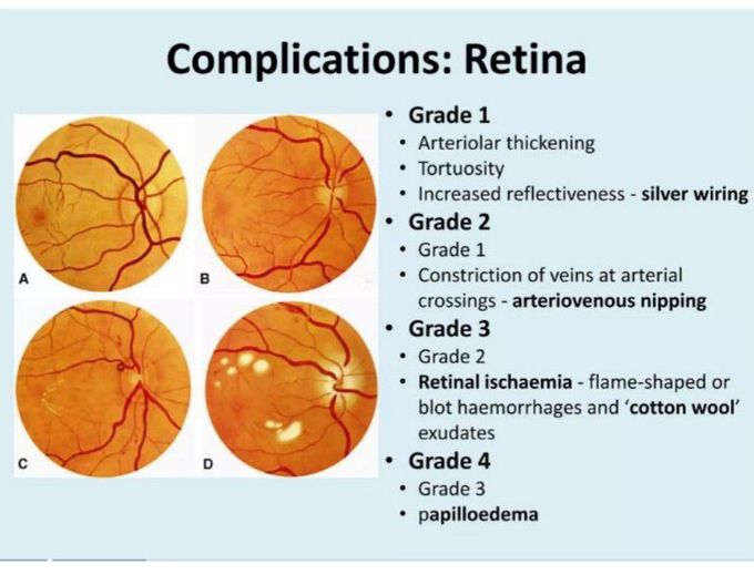 Hypertension Retinopathy -II