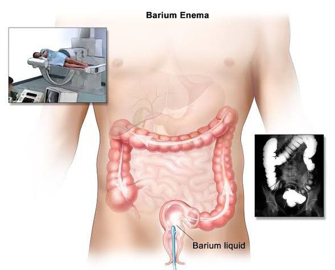 Contrast enema