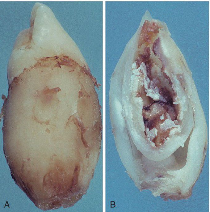 Coronal Dens Invaginatus Type II.