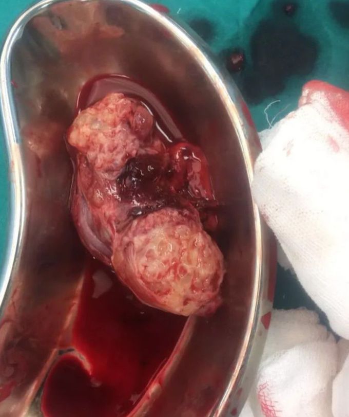 Tuberculosis of theTestis