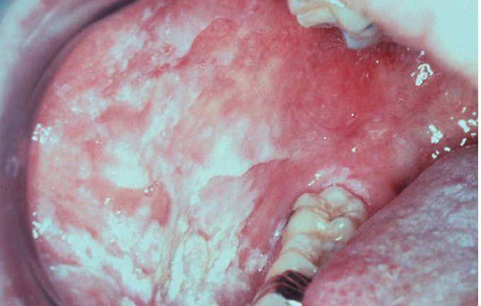 Hereditary Benign Intraepithelial Dyskeratosis (HBID).