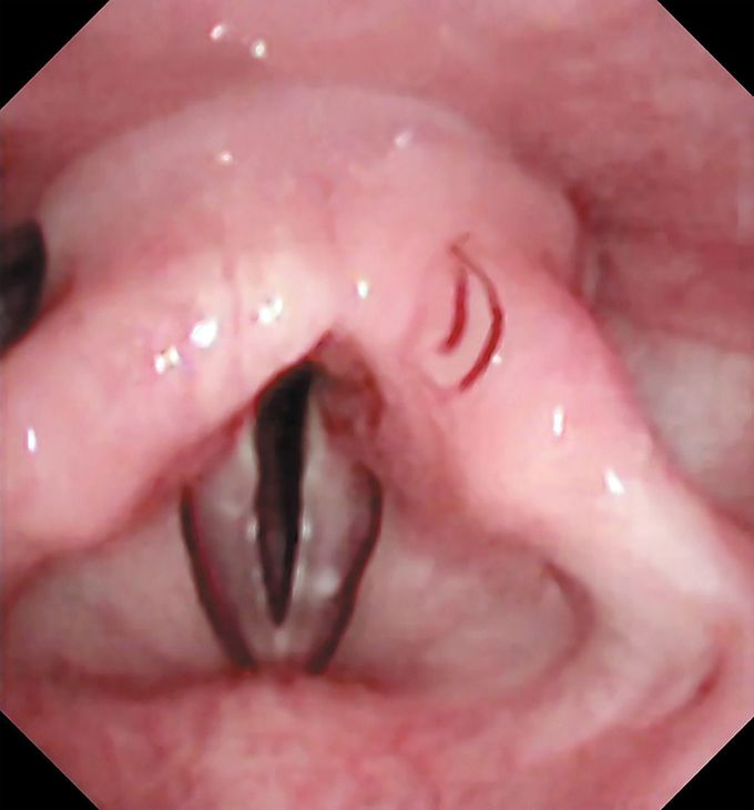 A Laryngeal Fluke
