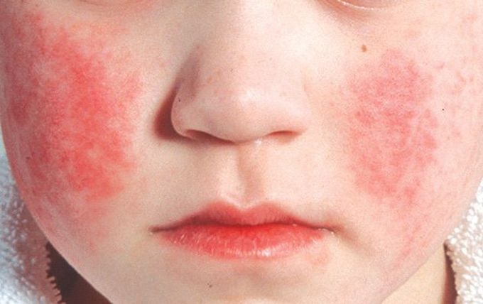 Fifth disease
