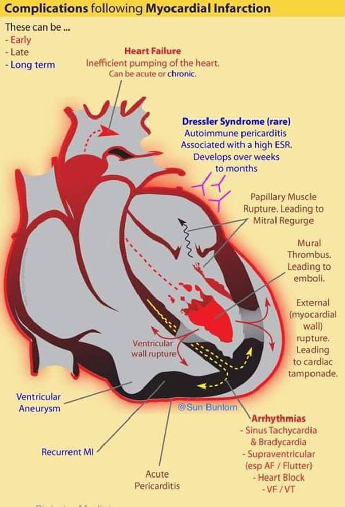 #M infarction