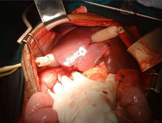 Balloon tamponade of a transhepatic liver gunshot wound