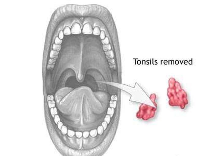 Tonsillectomy - MEDizzy