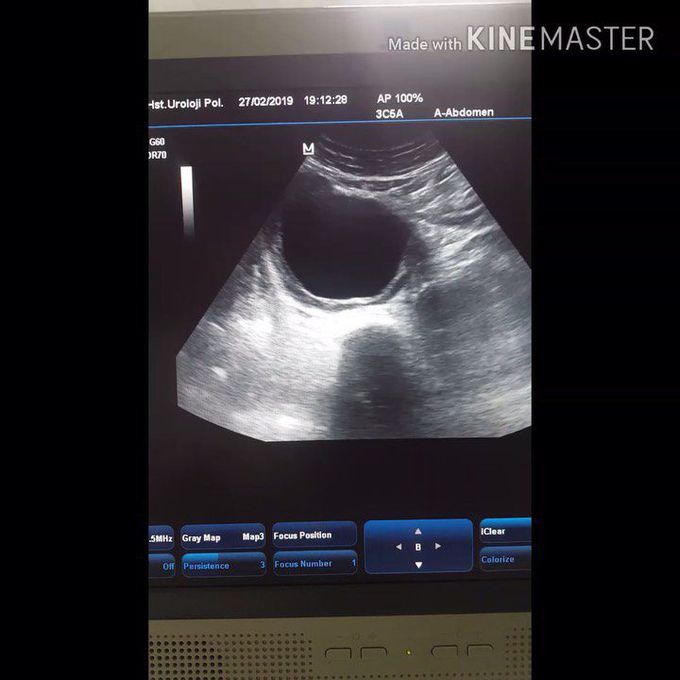 Abdominal Aortic Aneurism Rupture